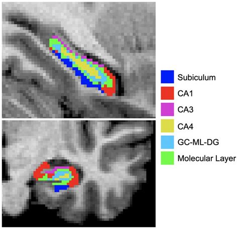 Frontiers Hippocampal Subfield Volumes In Treatment Resistant