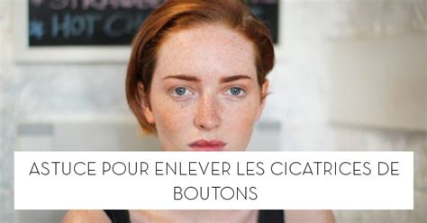 Astuce Pour Enlever Les Cicatrices De Boutons Le Blog StarOfService