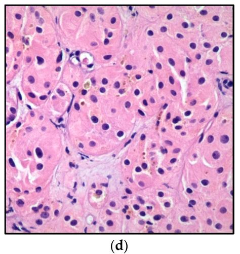 Metabolites Free Full Text The Leydig Steroid Cell Tumor In A