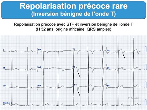 Ecg Sportif Normal E Cardiogram