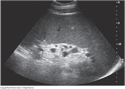 Chapter The Spleen Pathology Flashcards Quizlet