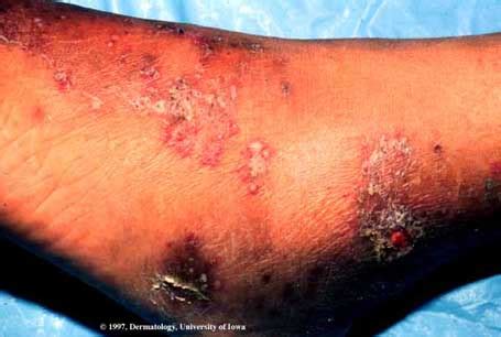 Pemphigus Foliaceus | Department of Dermatology