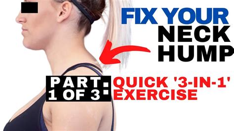 QUICK Fix For Neck Hump Dowager S Hump Fix How To Get Rid Of A Neck