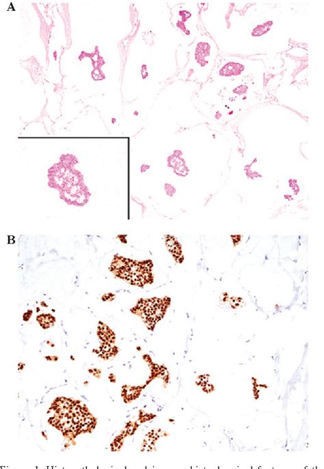 Figure 1 From Mucinous Carcinoma Occurring In The Male Breast