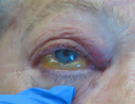 Eyelid Fungal Infection