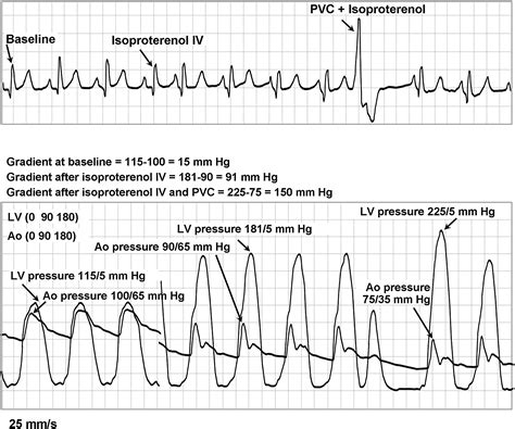 Intraoperative Direct Measurement Of Left Ventricular Outflow Tract