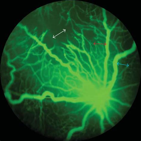 Fluorescein Angiogram And Corresponding Spectral Domain Optical Download Scientific Diagram