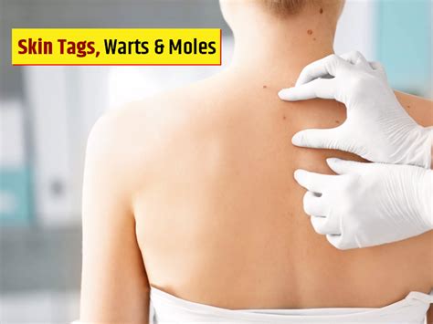 What Is The Difference Between A Wart And A Skin Tag At David Percy Blog