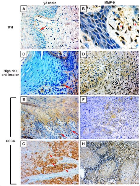 Expression Of Laminin Chain And Mmp In High Risk Of Malignant