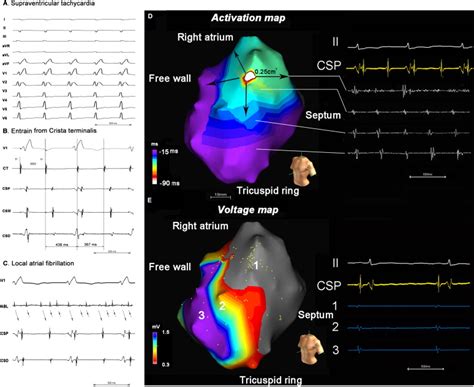 Electrocardiogram Intracardiac Electrogram With Entrainment And