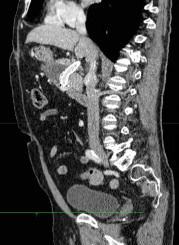 Extrahepatic Portal Vein Aneurysm Annals Of Vascular Surgery