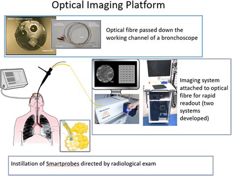 Image Showing A Bronchoscopy Procedure With The Imaging Fibre And