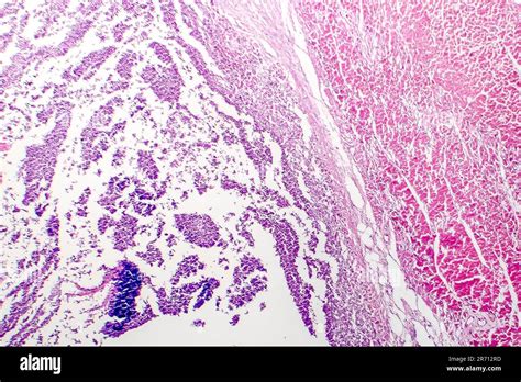 Histopathology Of Bacterial Myocarditis Inflammatory Heart Disease