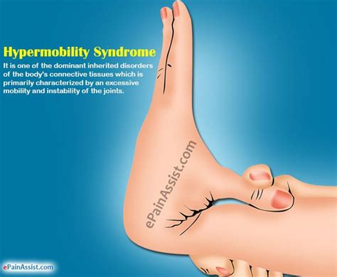 Hypermobility Syndrome (With images) | Hypermobility, Physical therapy ...