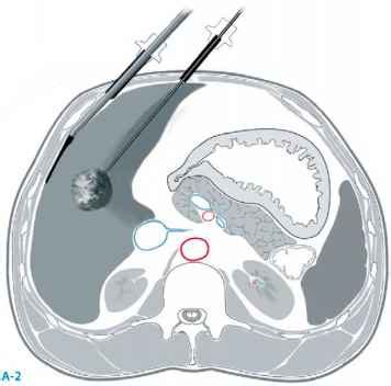 Radiofrequency Ablation of Liver Tumors - Hepatic Artery