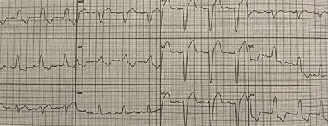 Ecg Dos Bloqueios De Ramo E Divisionais Sanar Medicina