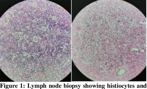 Figure 1 From Clinical Profile Of Secondary Hemophagocytic