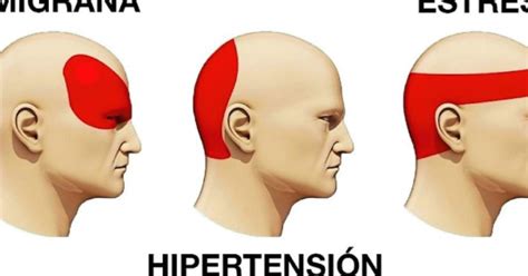 Sabías que los dolores de cabeza son diferentes