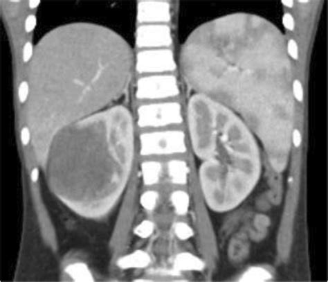 Localized Wilms Tumor In Low Middle Income Countries Lmic How Can