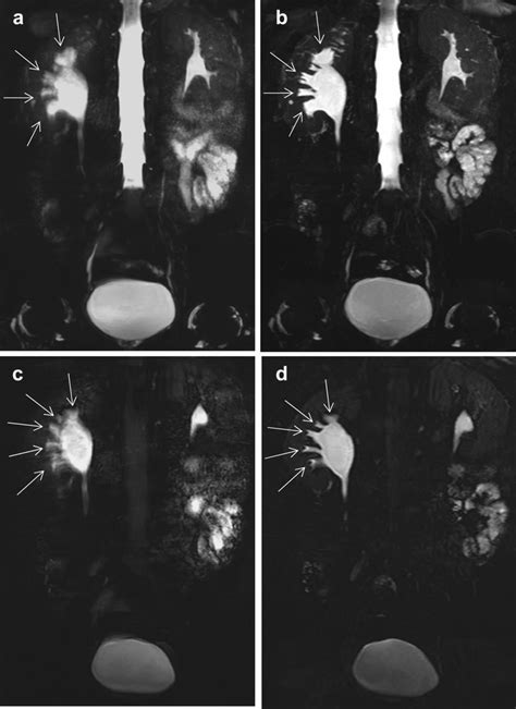 A 49-year-old male with right ureteropelvic junction obstruction. The... | Download Scientific ...