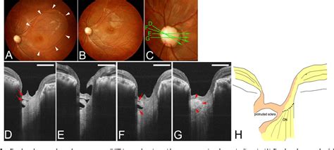 Evaluation Of Congenital Optic Disc Pits And Optic Disc Colobomas By