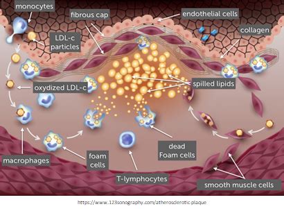 Pathophysiology Cardio 3A Flashcards Quizlet