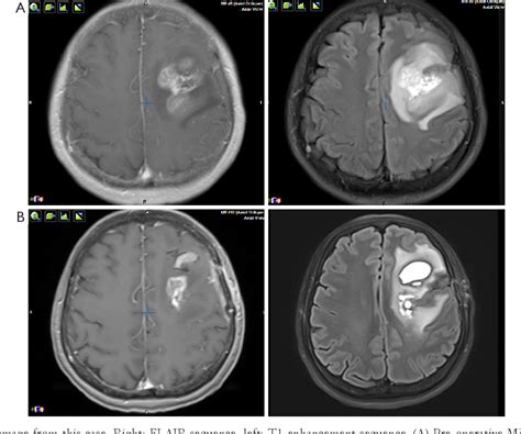 [pdf] Treatment Of Mgmt Promoter Unmethylated Glioblastoma With Pd 1