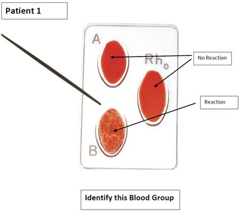 AP2 Blood Typing Signature Assignment Flashcards Flashcards Quizlet