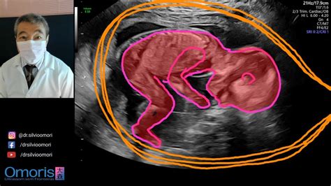 ULTRASSOM Menino Ou Menina 20 SEMANAS YouTube
