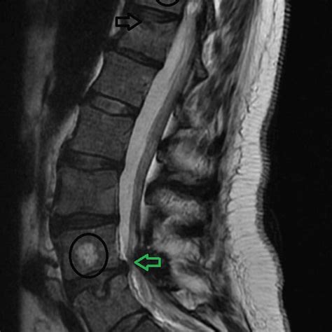 T Weighted Sagittal Magnetic Resonance Imaging Of The Lumbar Spine