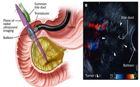 Pancreatic Cancer Mi Endoscopia