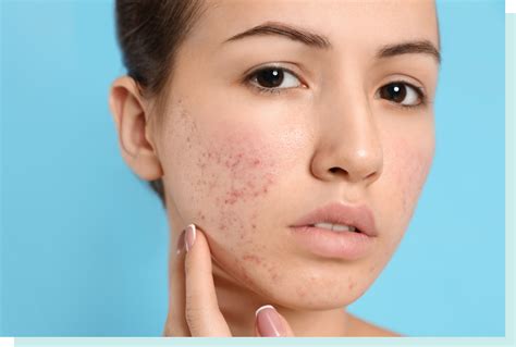 Acne Scars Treatment Calgary Silverado Aesthetic Clinic