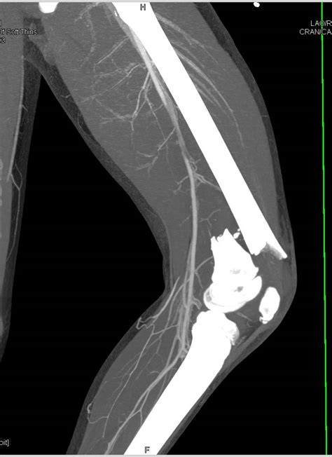 Comminuted Distal Femur Fracture