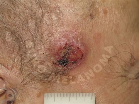 Merkel Cell Carcinoma Euromelanoma