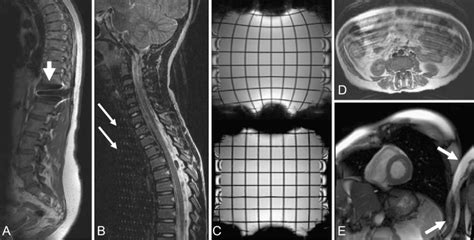 Characteristic Image Distortions In Mr A Susceptibility Artefact