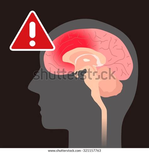 Cerebral Hemorrhage Image Illustration Stock Vector Royalty Free