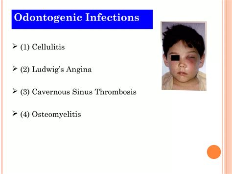 Odontogenic Infections 4 Ppt