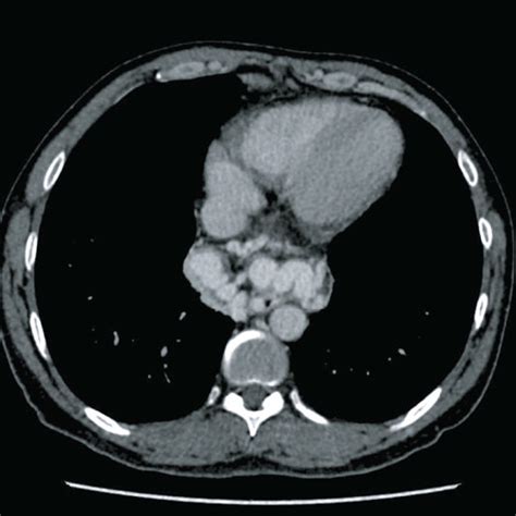 Ct And Endoscopic Ultrasonography Eus Findings Of Extraluminal Download Scientific Diagram