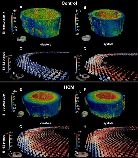 In Vivo Cardiovascular Magnetic Resonance Diffusion Tensor Imaging