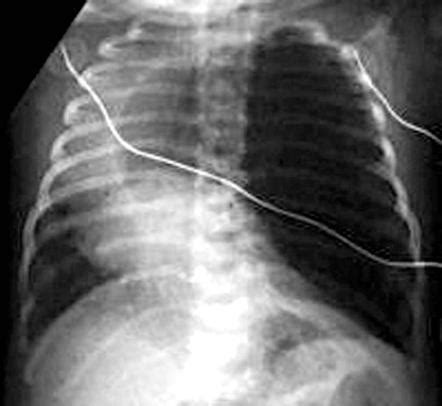 Congenital Lobar Emphysema Radiology Case Radiopaedia Org