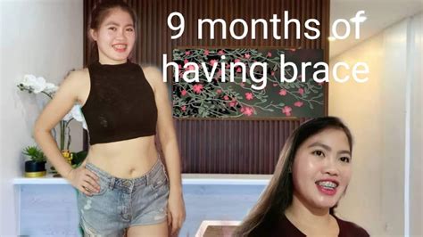 9 Months Of Having Dental Braces Adjustment Youtube