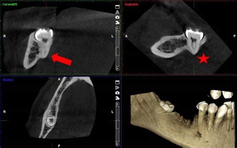 Tomograf A Computada Cone Beam Tercer Molar Mandibular Derecho