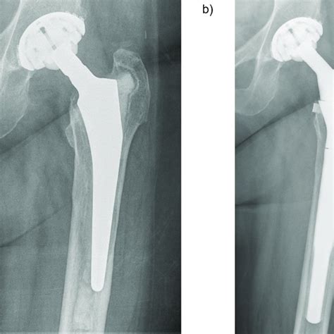 Pre And Postoperative Radiographs A Cemented Primary Tha With Aseptic Download Scientific