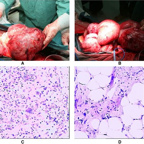 The Gross Appearance Of The Totally Excised Tumors Presented In The