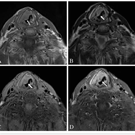 Contrast Enhanced Neck Mri Of The Mass Without Fat Suppression Download Scientific Diagram