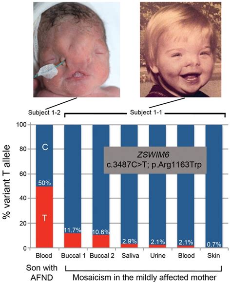 Acromelic Frontonasal Dysostosis And Zswim Mutation Phenotypic