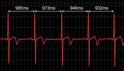 Ecg Graph With Hrv — Movesense