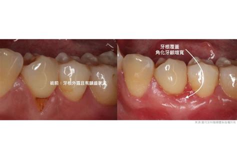 牙齦萎縮、牙縫變大牙周病不控制 問題多更多 最新資訊 當代牙醫數位植牙中心 桃園中壢植牙推薦 導航植牙全口重建all On 4