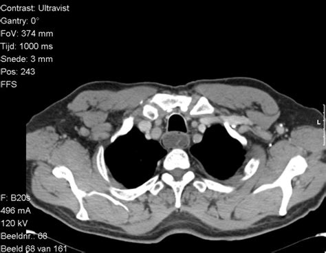 Ct Scan Showing The Large Polyp In The Esophagus Nearly Occluding The