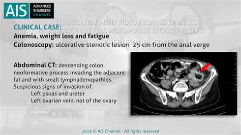 Laparoscopic Sigmoidectomy In A Locally Advanced Colon Tumor Youtube